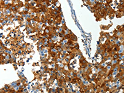 The image on the left is immunohistochemistry of paraffin-embedded Human breast cancer tissue using the antibody Antibody) at dilution 1/25, on the right is treated with synthetic peptide. (Original magnification: ×200)
