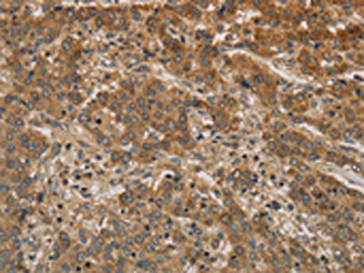The image on the left is immunohistochemistry of paraffin-embedded Human liver cancer tissue using IPO9 Antibody(IPO9 Antibody) at dilution 1/20, on the right is treated with synthetic peptide. (Original magnification: ×200)