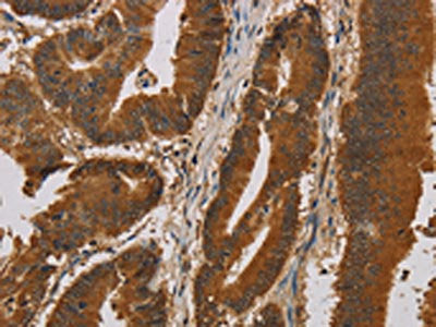 The image on the left is immunohistochemistry of paraffin-embedded Human colon cancer tissue using the antibody Antibody) at dilution 1/20, on the right is treated with synthetic peptide. (Original magnification: ×200)