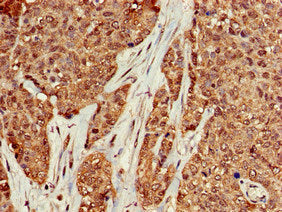 Immunohistochemistry of paraffin-embedded human ovarian cancer using the antibody at dilution of 1:100