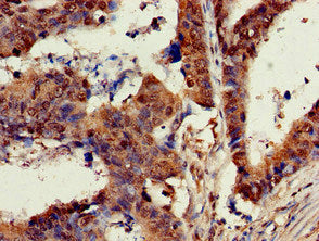 Immunohistochemistry of paraffin-embedded human colon cancer using KRAS Antibody at dilution of 1:100