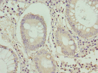 Immunohistochemistry of paraffin-embedded human colon cancer using the antibody at dilution of 1:100