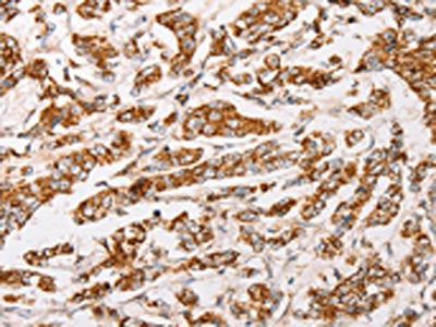 The image on the left is immunohistochemistry of paraffin-embedded Human breast cancer tissue using AK2 Antibody(AK2 Antibody) at dilution 1/30, on the right is treated with fusion protein. (Original magnification: ×200)Rabbit anti-Human AK2 Polyclonal Antibody