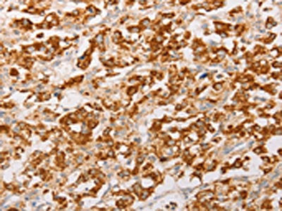 The image on the left is immunohistochemistry of paraffin-embedded Human thyroid cancer tissue using the antibody Antibody) at dilution 1/30, on the right is treated with fusion protein. (Original magnification: ×200)Rabbit anti-Human AK2 Polyclonal Antibody