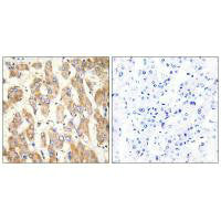Immunohistochemistry analysis of paraffin-embedded human liver carcinoma tissue using BAX antibody.