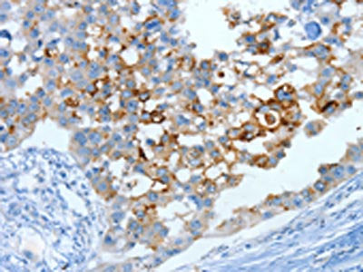 The image on the left is immunohistochemistry of paraffin-embedded Human breast cancer tissue using MUC15 Antibody(MUC15 Antibody) at dilution 1/25, on the right is treated with fusion protein. (Original magnification: ×200)Rabbit anti-Human MUC15 Polyclonal Antibody