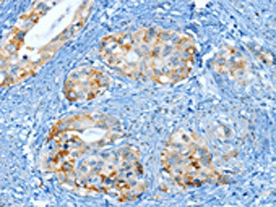 The image on the left is immunohistochemistry of paraffin-embedded Human cervical cancer tissue using the antibody Antibody) at dilution 1/25, on the right is treated with fusion protein. (Original magnification: ×200)Rabbit anti-Human MUC15 Polyclonal Antibody