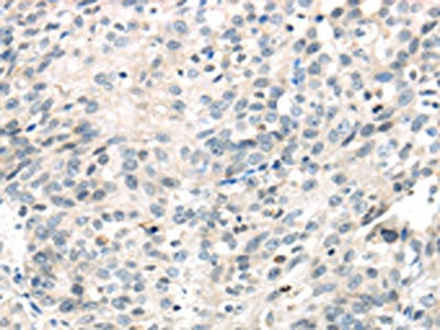 The image on the left is immunohistochemistry of paraffin-embedded Human ovarian cancer tissue using IQGAP2 Antibody(IQGAP2 Antibody) at dilution 1/40, on the right is treated with synthetic peptide. (Original magnification: ×200)