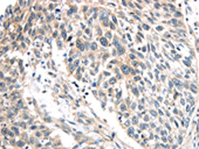 The image on the left is immunohistochemistry of paraffin-embedded Human lung cancer tissue using the antibody Antibody) at dilution 1/40, on the right is treated with synthetic peptide. (Original magnification: ×200)