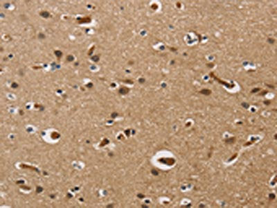The image on the left is immunohistochemistry of paraffin-embedded Human brain  tissue using UBE2S Antibody(UBE2S Antibody) at dilution 1/40, on the right is treated with fusion protein. (Original magnification: ×200)Rabbit anti-Human UBE2S Polyclonal Antibody