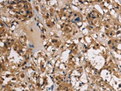 The image on the left is immunohistochemistry of paraffin-embedded Human thyroid cancer tissue using the antibody Antibody) at dilution 1/40, on the right is treated with fusion protein. (Original magnification: ×200)Rabbit anti-Human UBE2S Polyclonal Antibody