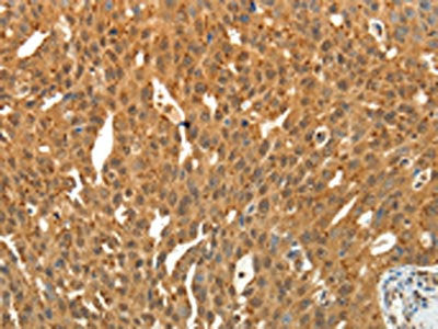 The image on the left is immunohistochemistry of paraffin-embedded Human ovarian cancer tissue using SIRT4 Antibody(SIRT4 Antibody) at dilution 1/25, on the right is treated with fusion protein. (Original magnification: ×200)Rabbit anti-Human SIRT4 Polyclonal Antibody