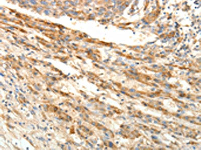 The image on the left is immunohistochemistry of paraffin-embedded Human liver cancer tissue using the antibody Antibody) at dilution 1/25, on the right is treated with fusion protein. (Original magnification: ×200)Rabbit anti-Human SIRT4 Polyclonal Antibody