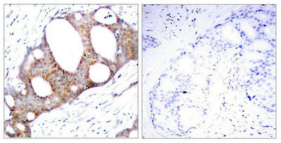 Immunohistochemical analysis of paraffin-embedded human breast carcinoma tissue using GSK3a(Phospho-Ser21) Antibody(left) or the same antibody preincubated with blocking peptide(right).Rabbit anti-Human GSK3A Polyclonal Antibody