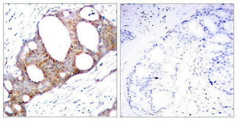 Immunohistochemical analysis of paraffin-embedded human breast carcinoma tissue using GSK3a(Phospho-Ser21) Antibody(left) or the same antibody preincubated with blocking peptide(right).Rabbit anti-Human GSK3A Polyclonal Antibody