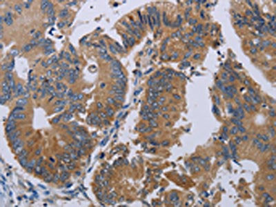 The image on the left is immunohistochemistry of paraffin-embedded Human colon cancer tissue using PRKD3 Antibody(PRKD3 Antibody) at dilution 1/50, on the right is treated with synthetic peptide. (Original magnification: ×200)Rabbit anti-Human PRKD3 Polyclonal Antibody