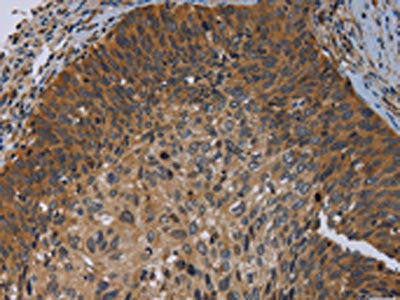 The image on the left is immunohistochemistry of paraffin-embedded Human cervical cancer tissue using the antibody Antibody) at dilution 1/50, on the right is treated with synthetic peptide. (Original magnification: ×200)Rabbit anti-Human PRKD3 Polyclonal Antibody