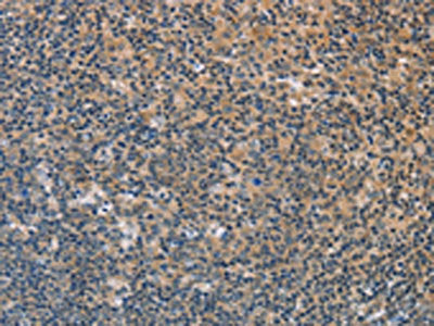 The image on the left is immunohistochemistry of paraffin-embedded Human tonsil tissue using the antibody Antibody) at dilution 1/60, on the right is treated with fusion protein. (Original magnification: ×200)Rabbit anti-Human FXYD1 Polyclonal Antibody