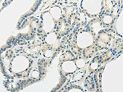The image on the left is immunohistochemistry of paraffin-embedded Human thyroid cancer tissue using SLC7A11 Antibody(SLC7A11 Antibody) at dilution 1/35, on the right is treated with synthetic peptide. (Original magnification: ×200)Rabbit anti-Human SLC7A11 Polyclonal Antibody