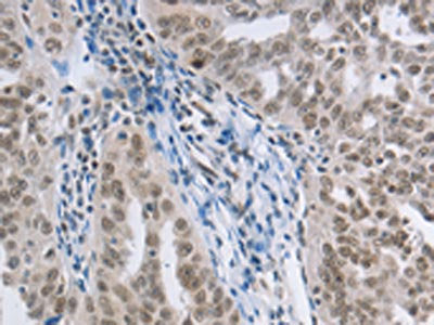 The image on the left is immunohistochemistry of paraffin-embedded Human ovarian cancer tissue using AKAP8 Antibody(AKAP8 Antibody) at dilution 1/15, on the right is treated with synthetic peptide. (Original magnification: ×200)Rabbit anti-Human AKAP8 Polyclonal Antibody
