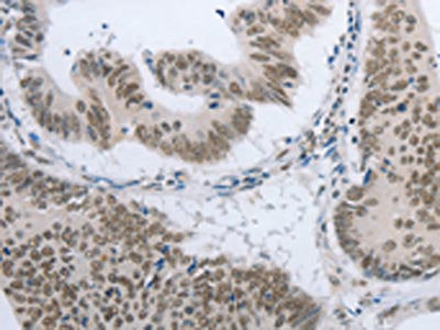 The image on the left is immunohistochemistry of paraffin-embedded Human colon cancer tissue using the antibody Antibody) at dilution 1/15, on the right is treated with synthetic peptide. (Original magnification: ×200)Rabbit anti-Human AKAP8 Polyclonal Antibody
