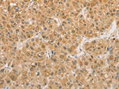 The image on the left is immunohistochemistry of paraffin-embedded Human liver cancer tissue using PGK2 Antibody(PGK2 Antibody) at dilution 1/50, on the right is treated with fusion protein. (Original magnification: ×200)Rabbit anti-Human PGK2 Polyclonal Antibody