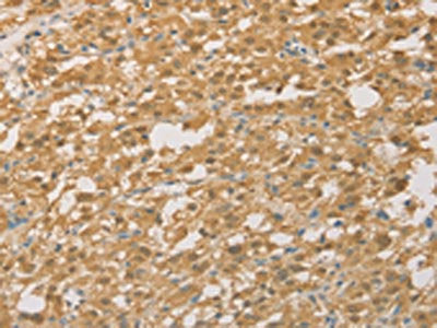 The image on the left is immunohistochemistry of paraffin-embedded Human thyroid cancer tissue using the antibody Antibody) at dilution 1/50, on the right is treated with fusion protein. (Original magnification: ×200)Rabbit anti-Human PGK2 Polyclonal Antibody