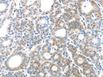 The image on the left is immunohistochemistry of paraffin-embedded Human thyroid cancer tissue using MAGED1 Antibody(MAGED1 Antibody) at dilution 1/30, on the right is treated with fusion protein. (Original magnification: ×200)