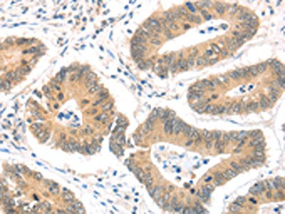 The image on the left is immunohistochemistry of paraffin-embedded Human colon cancer tissue using the antibody Antibody) at dilution 1/30, on the right is treated with fusion protein. (Original magnification: ×200)
