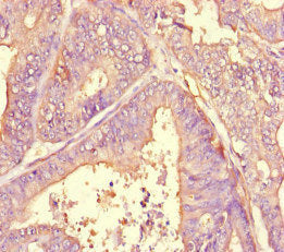 Immunohistochemistry of paraffin-embedded human endometrial cancer using A2M Antibody at dilution of 1:100Rabbit anti-Human A2M Polyclonal Antibody