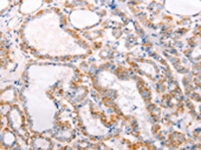 The image on the left is immunohistochemistry of paraffin-embedded Human thyroid cancer tissue using TRAF5 Antibody(TRAF5 Antibody) at dilution 1/30, on the right is treated with fusion protein. (Original magnification: ×200)Rabbit anti-Human TRAF5 Polyclonal Antibody