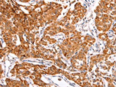 The image on the left is immunohistochemistry of paraffin-embedded Human lung cancer tissue using the antibody Antibody) at dilution 1/30, on the right is treated with fusion protein. (Original magnification: ×200)Rabbit anti-Human TRAF5 Polyclonal Antibody