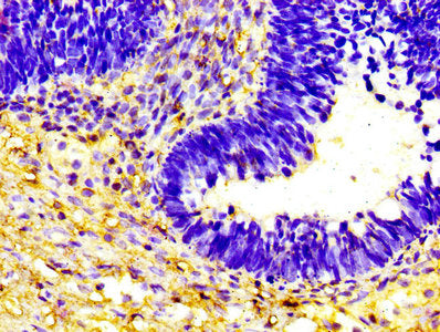 IHC image of HP Antibody diluted at 1:600 and staining in paraffin-embedded human ovarian cancer performed on a Leica BondTM system. After dewaxing and hydration, antigen retrieval was mediated by high pressure in a citrate buffer (pH 6.0). Section was blocked with 10% normal goat serum 30min at RT. Then primary antibody (1% BSA) was incubated at 4°C overnight. The primary is detected by a biotinylated secondary antibody and visualized using an HRP conjugated SP system.Rabbit anti-Human HP Polyclonal Antibody