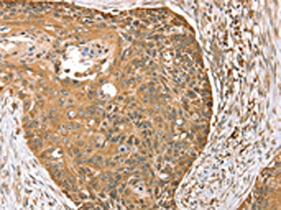The image on the left is immunohistochemistry of paraffin-embedded Human esophagus cancer tissue using MORF4L1 Antibody(MORF4L1 Antibody) at dilution 1/35, on the right is treated with synthetic peptide. (Original magnification: ×200)