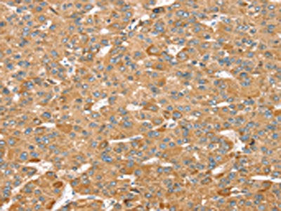 The image on the left is immunohistochemistry of paraffin-embedded Human liver cancer tissue using the antibody Antibody) at dilution 1/35, on the right is treated with synthetic peptide. (Original magnification: ×200)