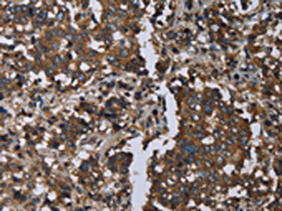 The image on the left is immunohistochemistry of paraffin-embedded Human liver cancer tissue using GOLGA2 Antibody(GOLGA2 Antibody) at dilution 1/60, on the right is treated with fusion protein. (Original magnification: ×200)Rabbit anti-Human GOLGA2 Polyclonal Antibody