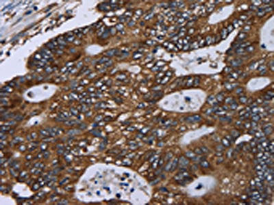 The image on the left is immunohistochemistry of paraffin-embedded Human colon cancer tissue using the antibody Antibody) at dilution 1/60, on the right is treated with fusion protein. (Original magnification: ×200)Rabbit anti-Human GOLGA2 Polyclonal Antibody