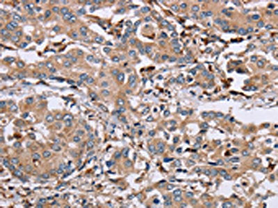 The image on the left is immunohistochemistry of paraffin-embedded Human liver cancer tissue using MAGEA3 Antibody(MAGEA3 Antibody) at dilution 1/50, on the right is treated with synthetic peptide. (Original magnification: ×200)