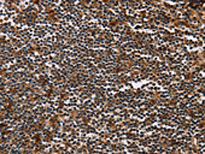 The image on the left is immunohistochemistry of paraffin-embedded Human tonsil tissue using the antibody Antibody) at dilution 1/50, on the right is treated with synthetic peptide. (Original magnification: ×200)
