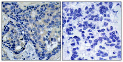 Immunohistochemical analysis of paraffin-embedded human breast carcinoma tissue using Pyk2(Phospho-Tyr402) Antibody(left) or the same antibody preincubated with blocking peptide(right).Rabbit anti-Human PTK2B Polyclonal Antibody