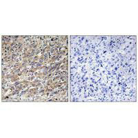 Immunohistochemistry analysis of paraffin-embedded human liver carcinoma tissue using COX17 antibody.Rabbit anti-Human COX17 Polyclonal Antibody