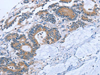 The image on the left is immunohistochemistry of paraffin-embedded Human colon cancer tissue using STMN1 Antibody(STMN1 Antibody) at dilution 1/20, on the right is treated with synthetic peptide. (Original magnification: ×200)Rabbit anti-Human STMN1 Polyclonal Antibody