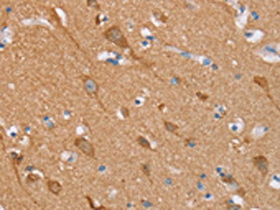 The image on the left is immunohistochemistry of paraffin-embedded Human brain tissue using the antibody Antibody) at dilution 1/20, on the right is treated with synthetic peptide. (Original magnification: ×200)Rabbit anti-Human STMN1 Polyclonal Antibody
