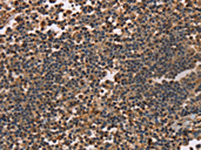 The image on the left is immunohistochemistry of paraffin-embedded Human tonsil tissue using the antibody Antibody) at dilution 1/40, on the right is treated with synthetic peptide. (Original magnification: ×200)