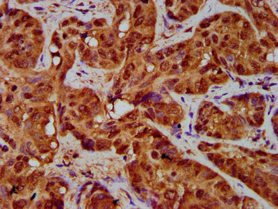 IHC image of the antibody diluted at 1:200 and staining in paraffin-embedded human liver cancer performed on a Leica BondTM system. After dewaxing and hydration, antigen retrieval was mediated by high pressure in a citrate buffer (pH 6.0). Section was blocked with 10% normal goat serum 30min at RT. Then primary antibody (1% BSA) was incubated at 4°C overnight. The primary is detected by a biotinylated secondary antibody and visualized using an HRP conjugated SP system.Rabbit anti-Human TFR2 Polyclonal Antibody
