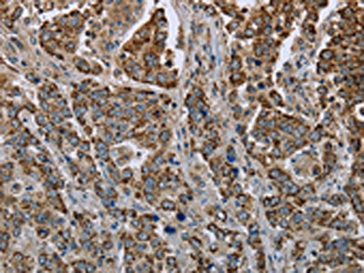The image on the left is immunohistochemistry of paraffin-embedded Human liver cancer tissue using GOT2 Antibody(GOT2 Antibody) at dilution 1/50, on the right is treated with fusion protein. (Original magnification: ×200)Rabbit anti-Human GOT2 Polyclonal Antibody
