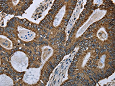 The image on the left is immunohistochemistry of paraffin-embedded Human colon cancer tissue using the antibody Antibody) at dilution 1/50, on the right is treated with fusion protein. (Original magnification: ×200)Rabbit anti-Human GOT2 Polyclonal Antibody