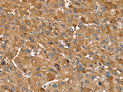 The image on the left is immunohistochemistry of paraffin-embedded Human liver cancer tissue using the antibody Antibody) at dilution 1/30, on the right is treated with synthetic peptide. (Original magnification: ×200)Rabbit anti-Human TRIM34 Polyclonal Antibody