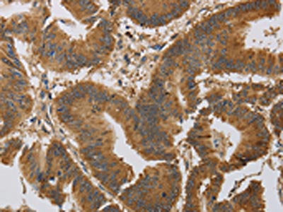 The image on the left is immunohistochemistry of paraffin-embedded Human colon cancer tissue using the antibody Antibody) at dilution 1/30, on the right is treated with synthetic peptide. (Original magnification: ×200)