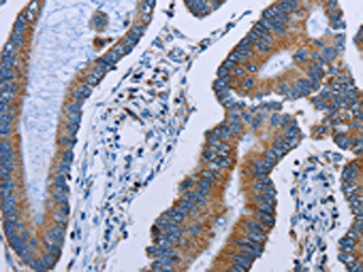 The image on the left is immunohistochemistry of paraffin-embedded Human colon cancer tissue using IDH2 Antibody(IDH2 Antibody) at dilution 1/60, on the right is treated with fusion protein. (Original magnification: ×200)Rabbit anti-Human IDH2 Polyclonal Antibody